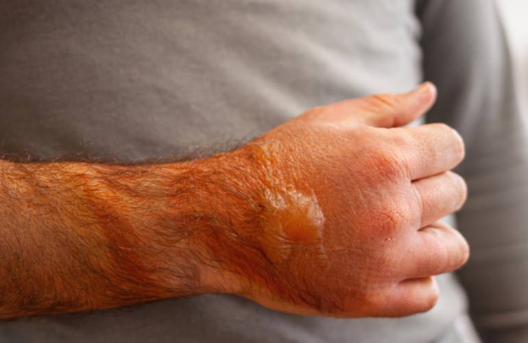 Burn and Scald Injury Claims